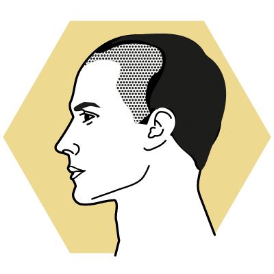 MALECOR-Hair_Geheimratsecken_icon