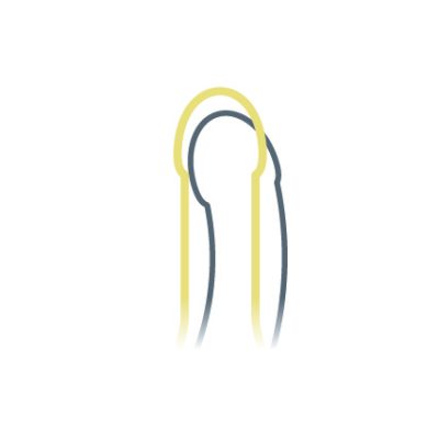 MALECOR_Penisverkrümmung-hell_intim